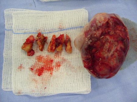 Adenoma pleiomorfo.peça cirúrgica.jpg